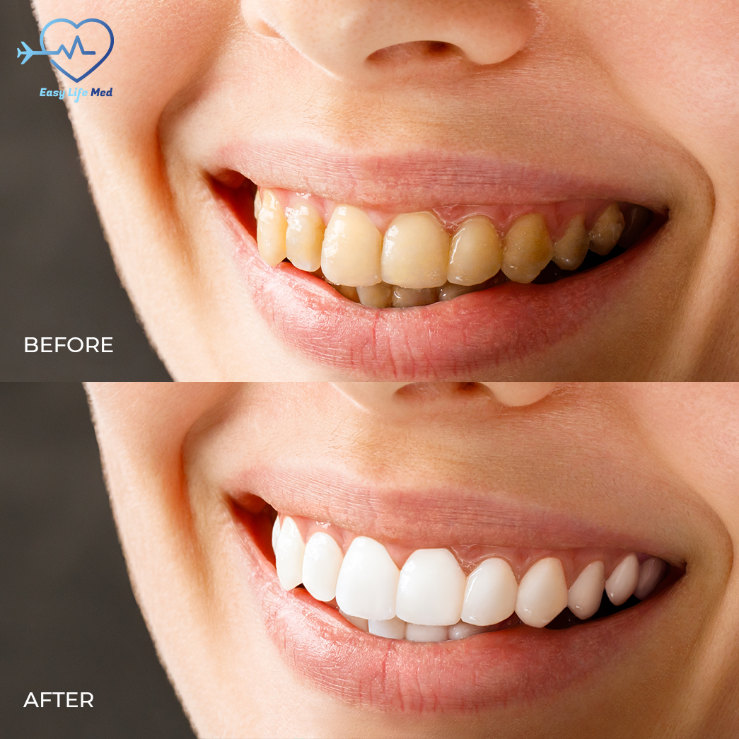 Dental treatments bleaching before after