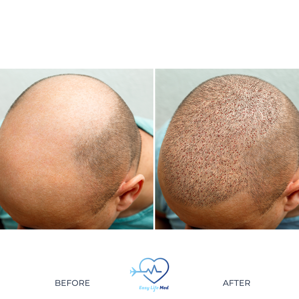 Hair transplantation with DHI technique before and after 
