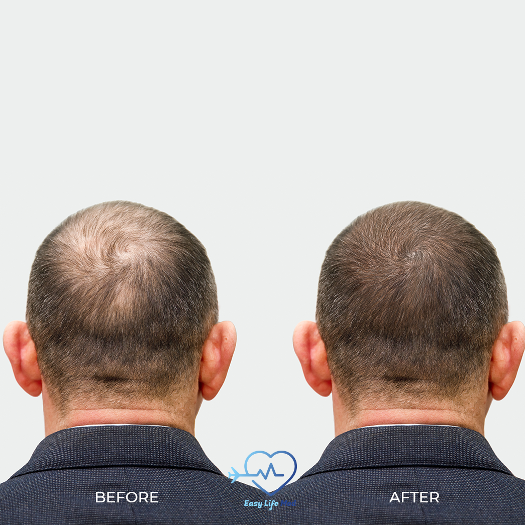Hair transplantation with fue technique  before and after 